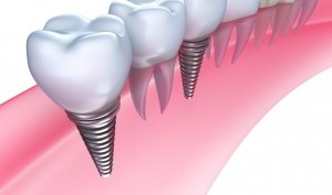 Dental Implant, dentist regina, dental clinic regina, orthodontist regina