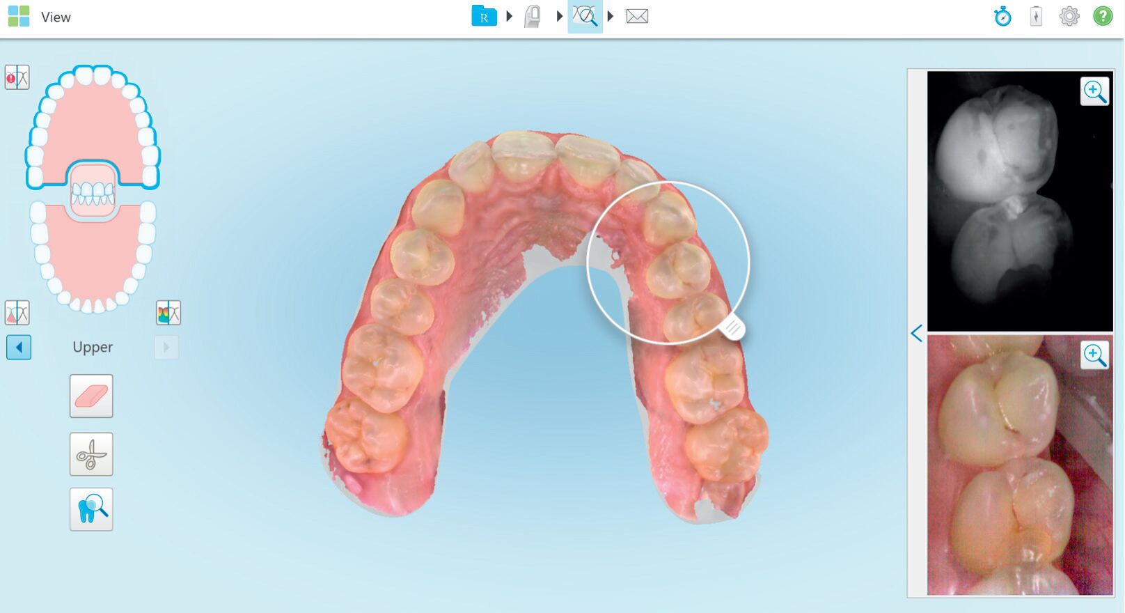 Radiation free caries detection with iTero Element 5D NIRI technology