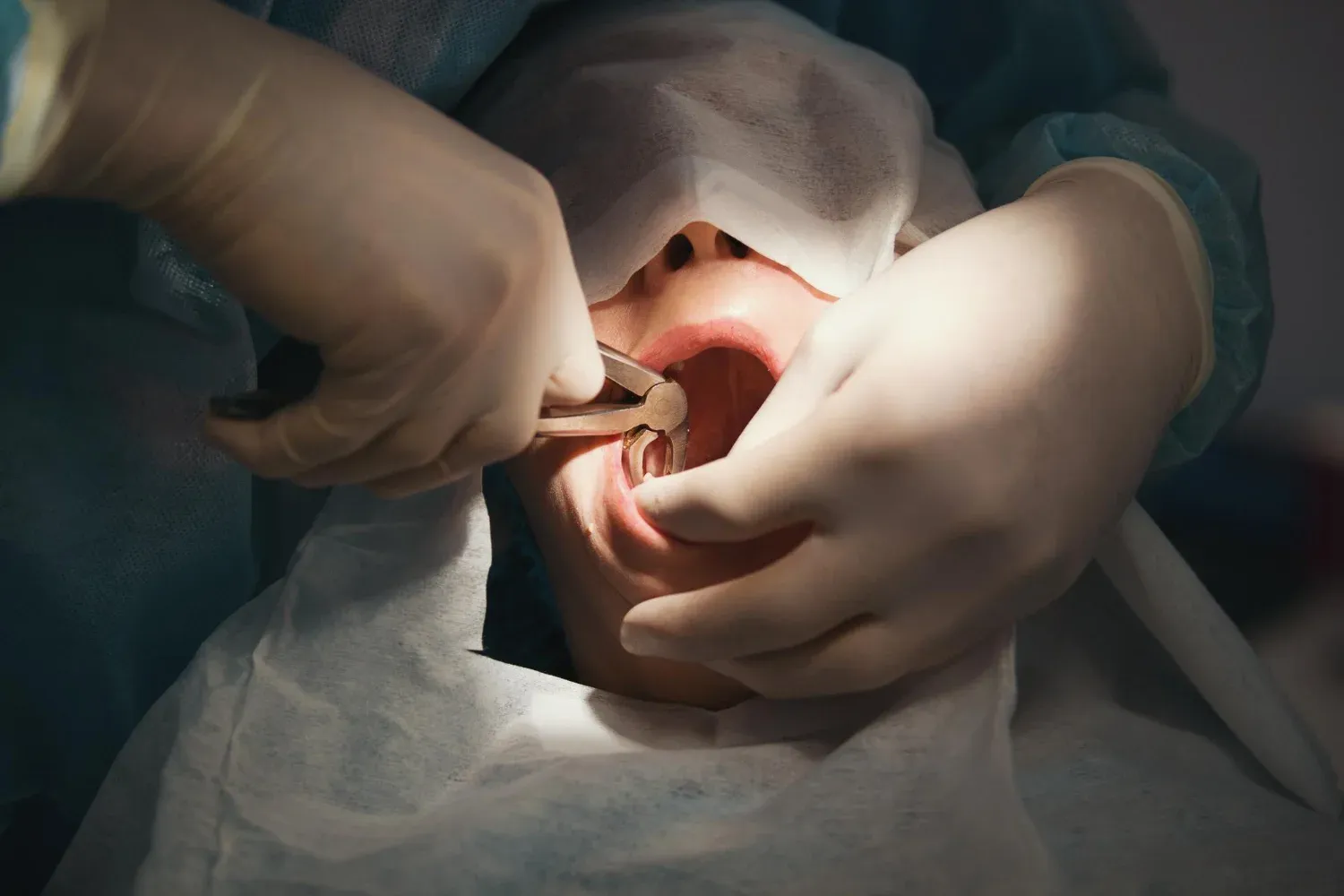 best wisdom teeth removal dentist