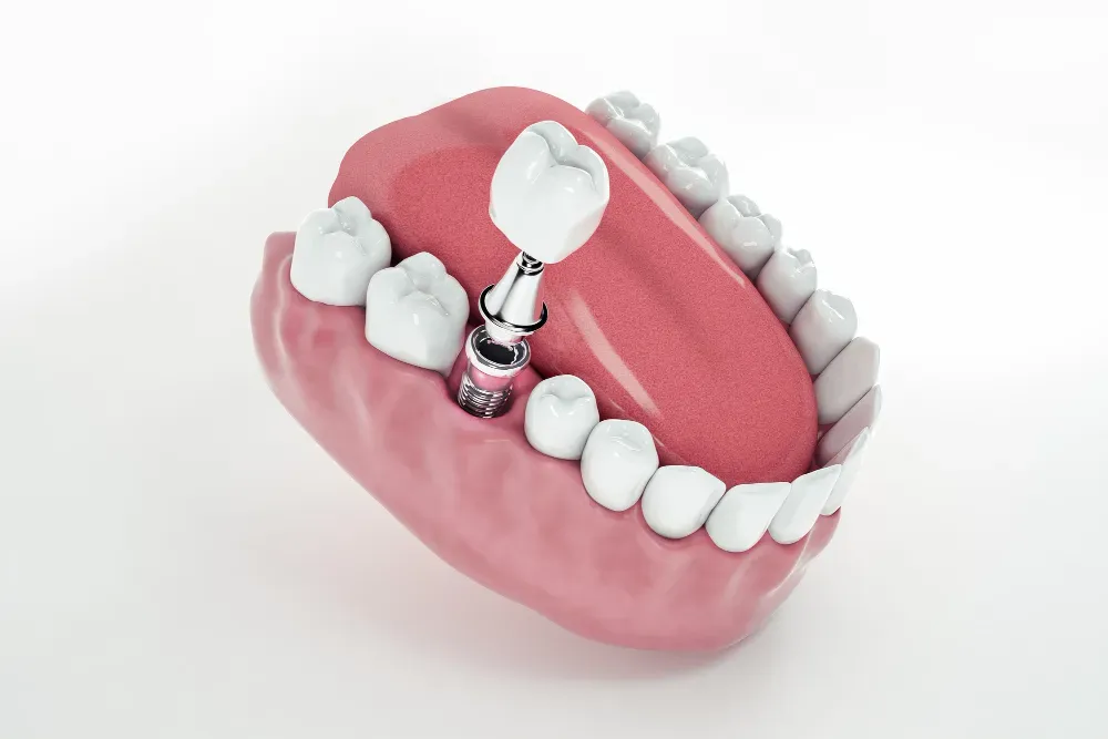 Basics of Dental Implants