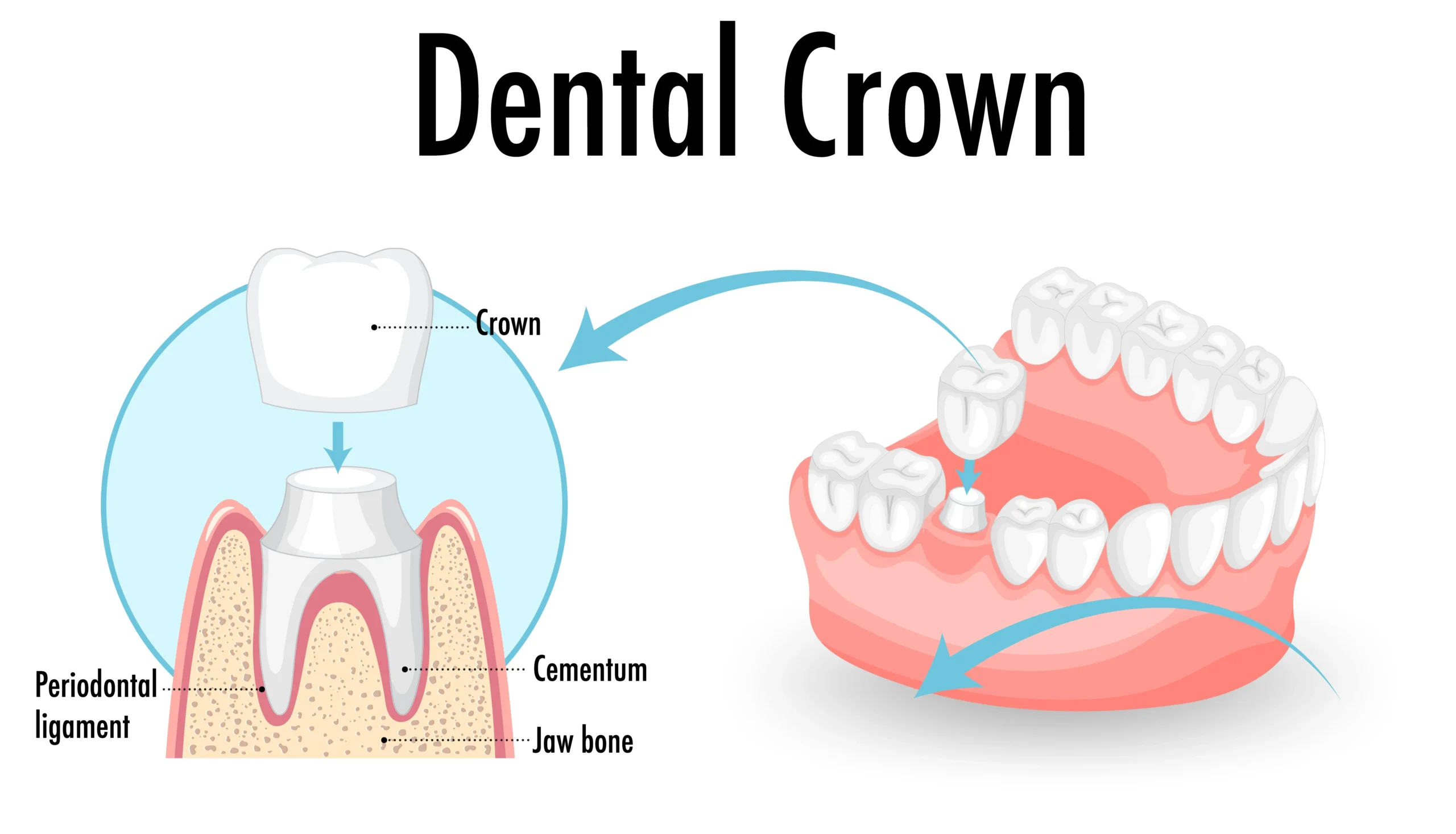 Dental crown in Regina