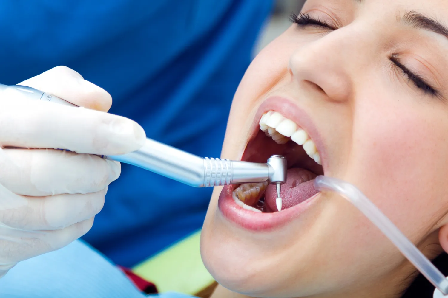 Experience dental scaling in Regina