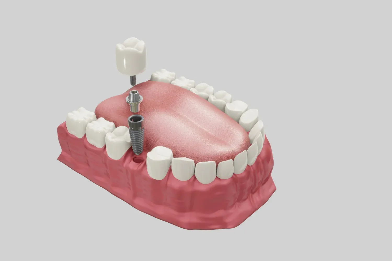 Optimal dental crown procedure