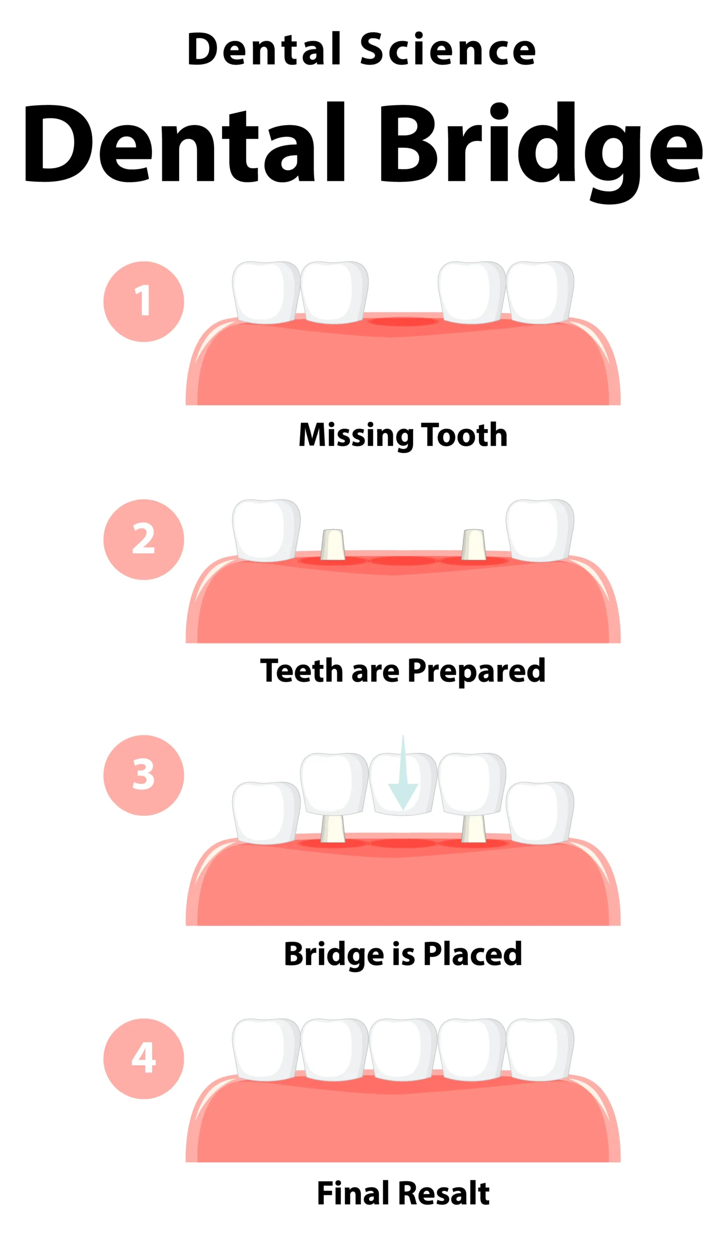 Premium dental bridge consultation