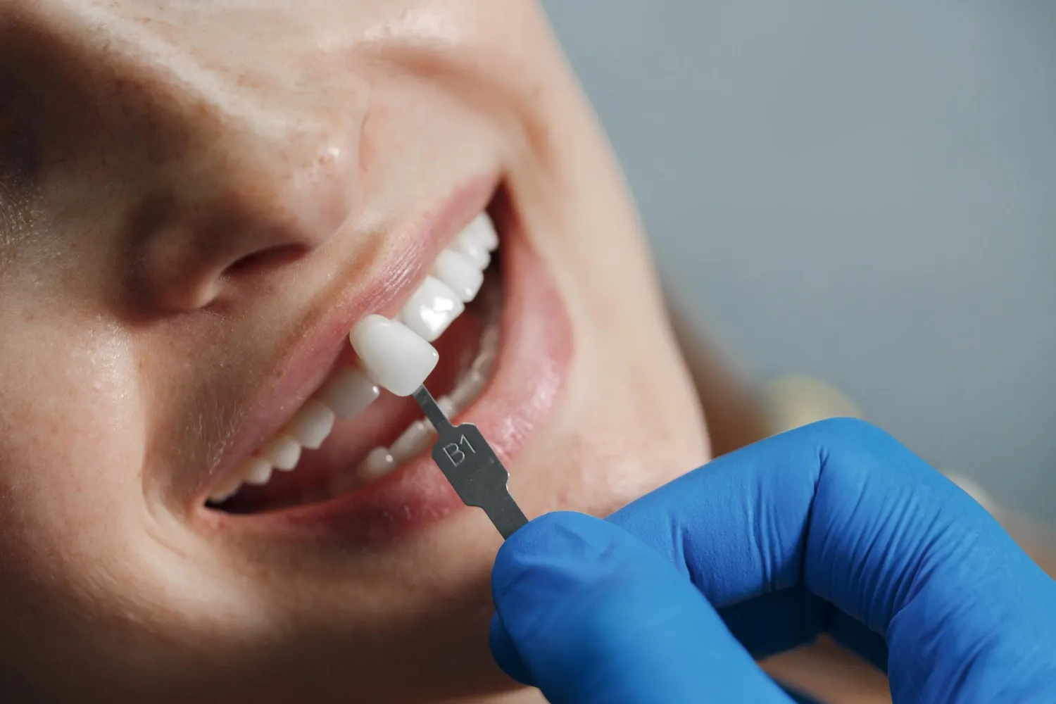 dental scaling in regina