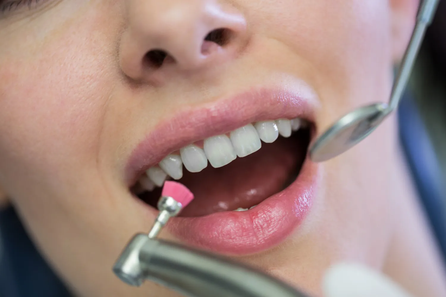 dental scaling treatment