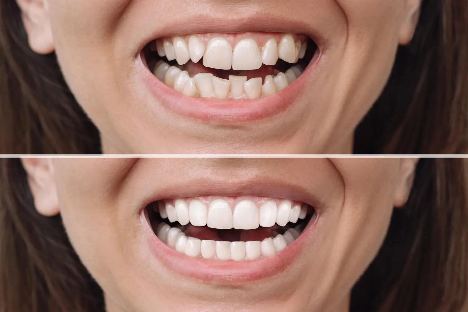 how do veneers work