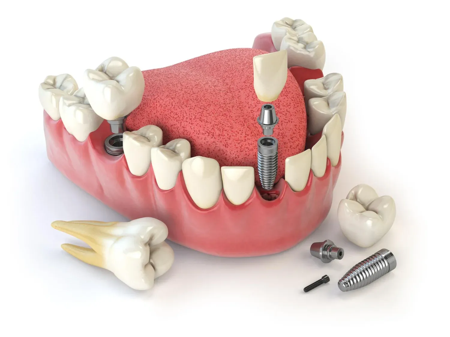 what is a dental bridge