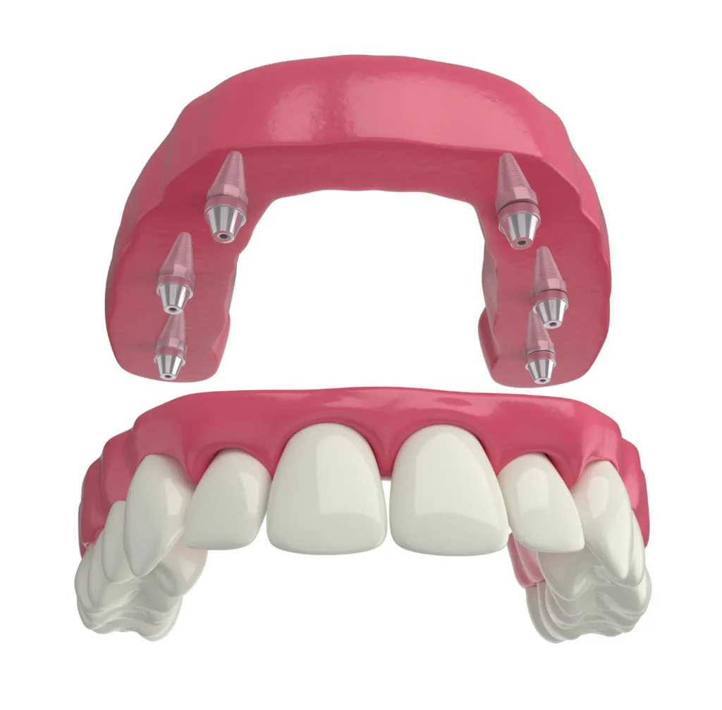 Benefits of Opting for Dental Bridges and Crowns